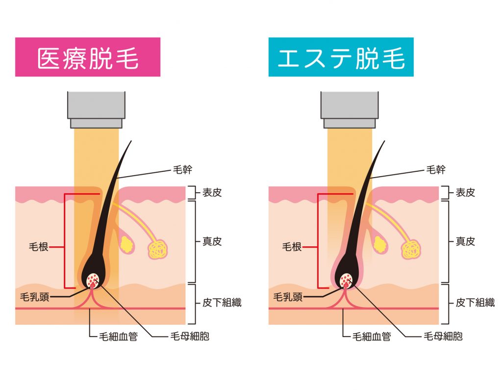【永久脱毛】医療レーザー脱毛の選び方ランキング